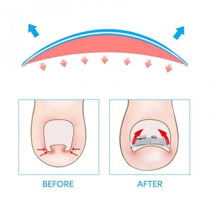 Νάρθηκας Ονυχοκρύπτωσης Μεταλλικός Με Προέκταση